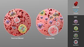 Leukemia Cancer