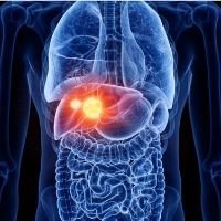 Liver Cancer