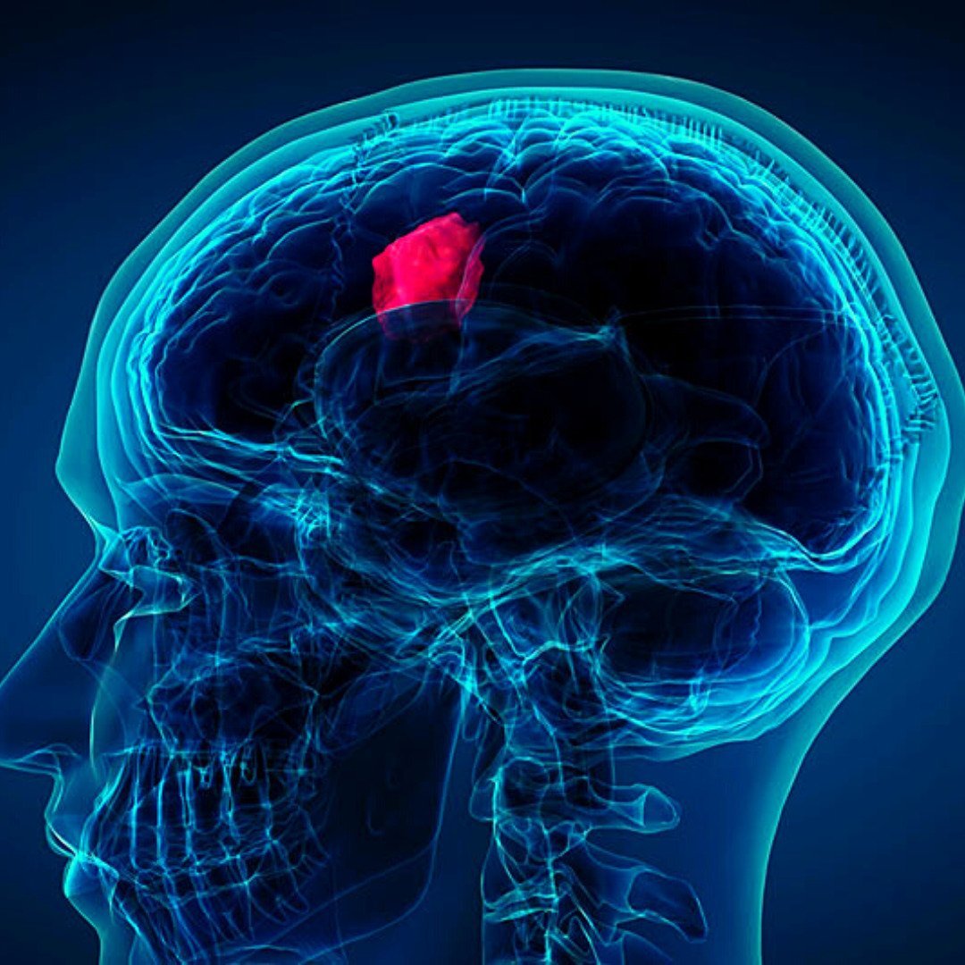 Brain Tumor Surgery Cost in India