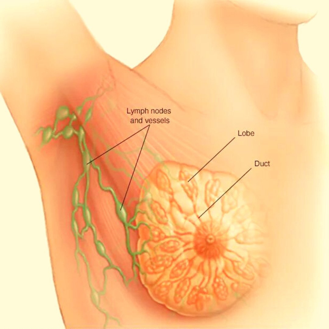 Breast Cancer Treatment Cost in India