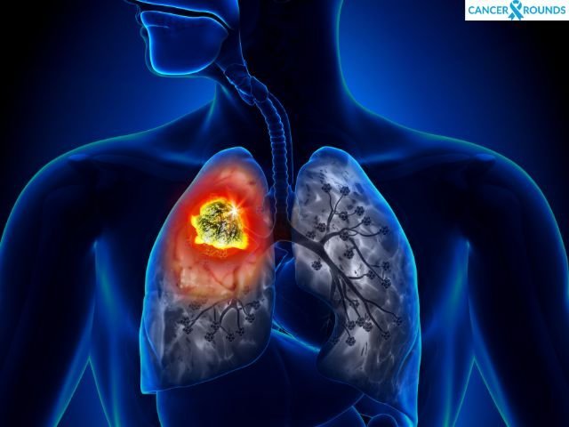 Lung Cancer Treatment Cost