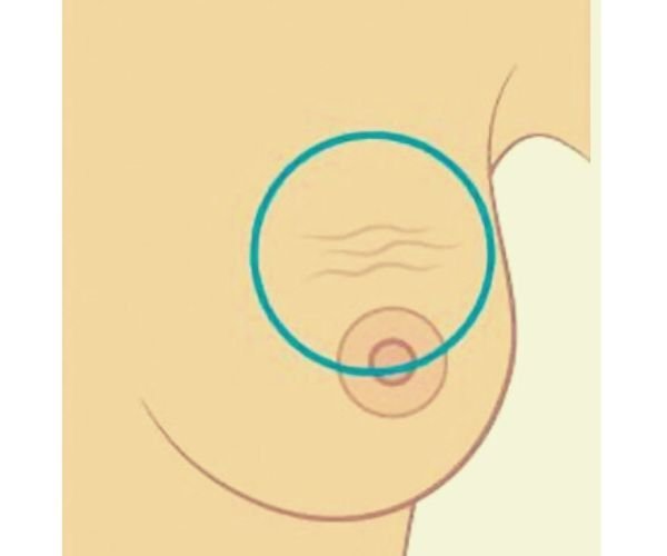 Common Signs & Symptoms of Breast Cancer