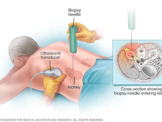 Kidney Biopsy Cost in India