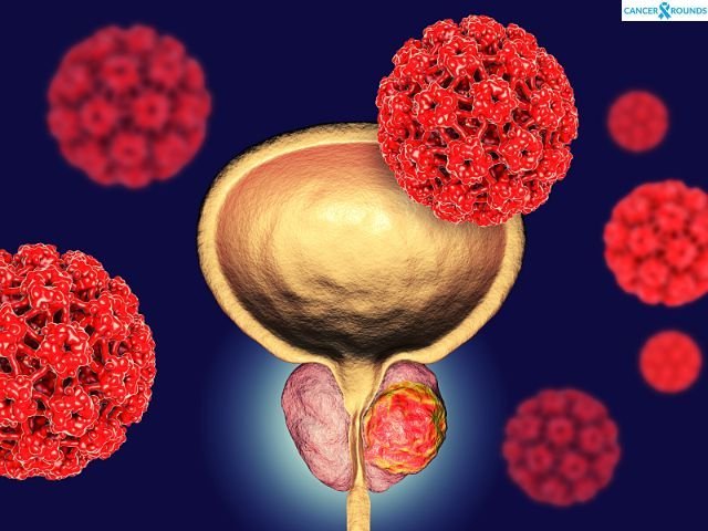 Symptoms of prostate cancer