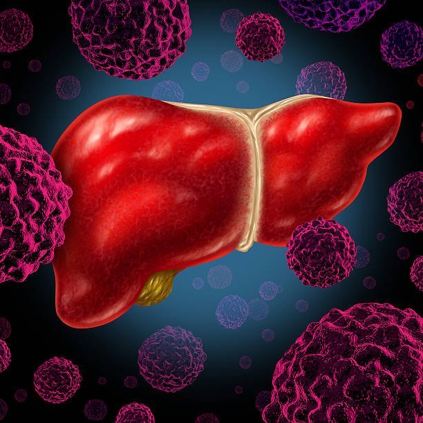 Sign & Symptoms of Liver Cancer