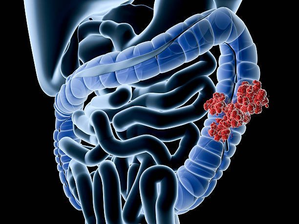 Signs & Symptoms of Colon Cancer