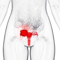 Ovarian Cancer